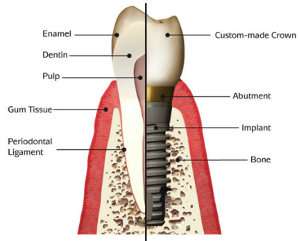 dental implant vs tooth